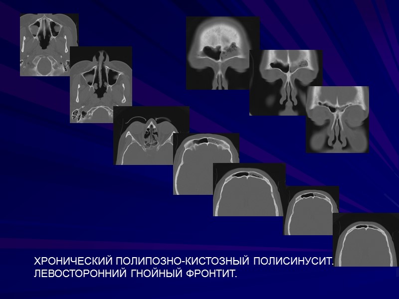 ХРОНИЧЕСКИЙ ПОЛИПОЗНО-КИСТОЗНЫЙ ПОЛИСИНУСИТ. ЛЕВОСТОРОННИЙ ГНОЙНЫЙ ФРОНТИТ.